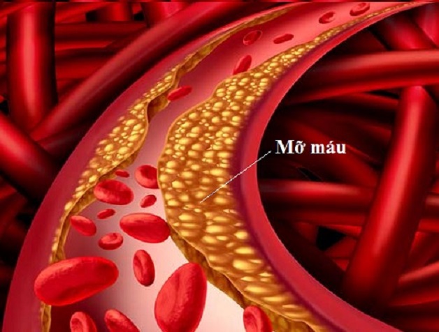 omega 3 chống đột quỵ