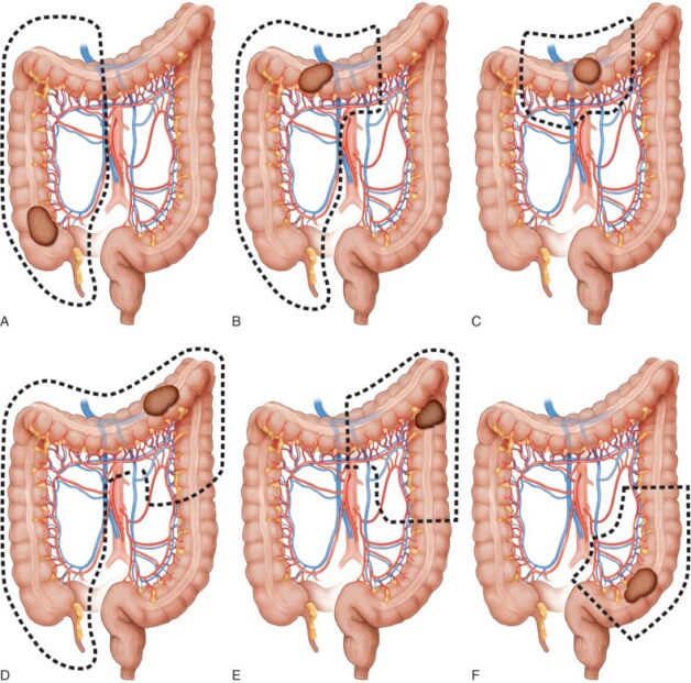Tìm hiểu cách điều trị bệnh ung thư đại trực tràng