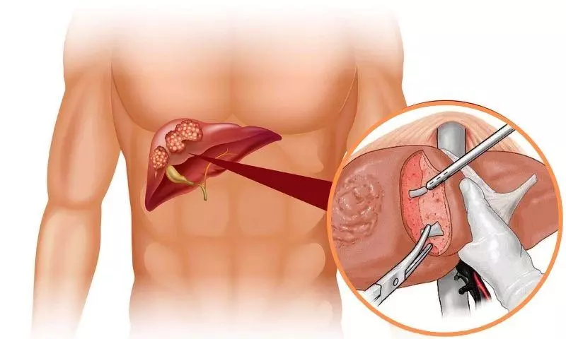 Ung thư gan điều trị phẫu thuật