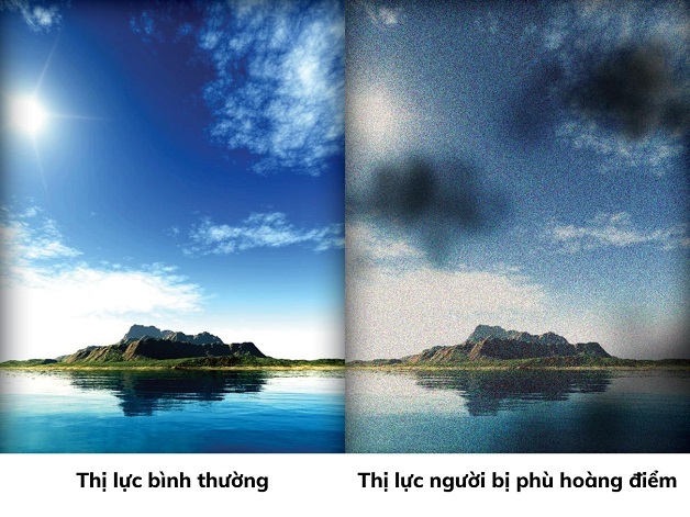 phù võng mạc