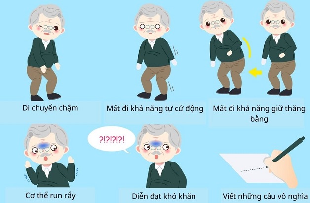 Sinh lý bệnh parkinson với các triệu chứng vận động