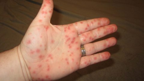 Phân biệt giữa sốt xuất huyết và sốt rét