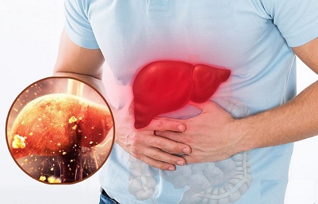 Sốt xuất huyết biến chứng vào gan như thế nào?
