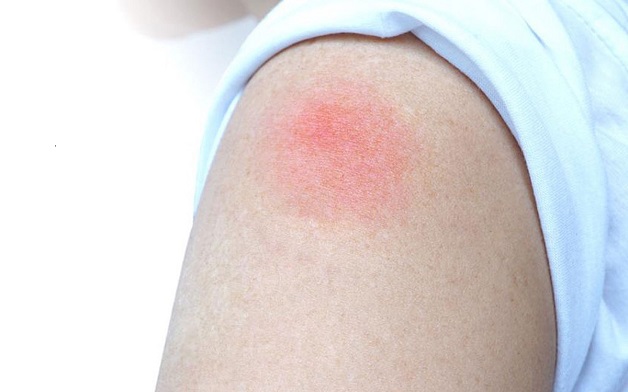 tiêm vắc xin uốn ván bị sưng tay
