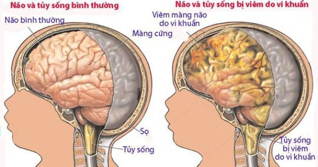 Hiểu rõ về vắc xin phòng viêm màng não mủ