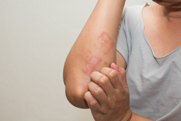 Trường hợp chống chỉ định tiêm vắc xin Havax