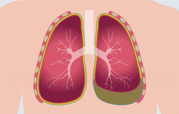 Cảnh giác mức độ nguy hiểm và những biến chứng sốt xuất huyết
