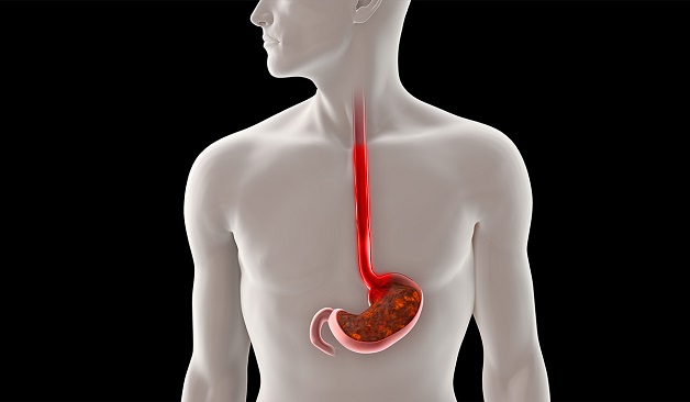 Trào ngược dạ dày có thể gây rối loạn nhịp tim không?