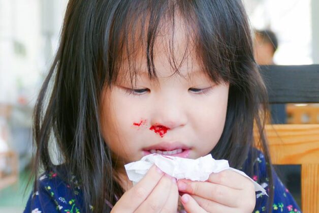 Trẻ cho dị vật vào mũi