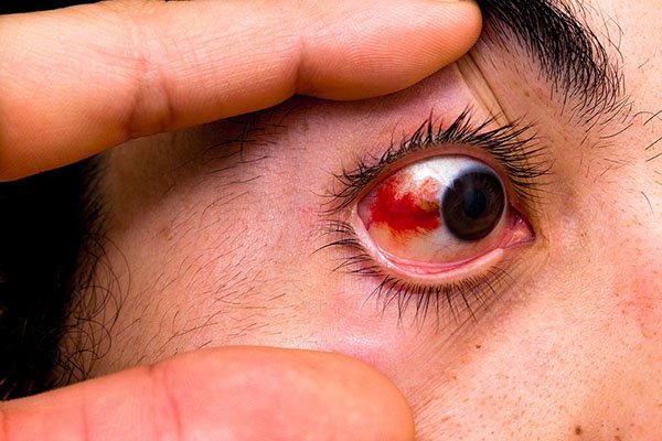 triệu chứng đau mắt đỏ