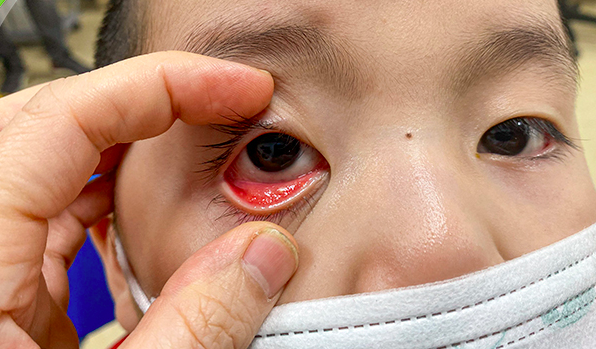 triệu chứng đau mắt đỏ