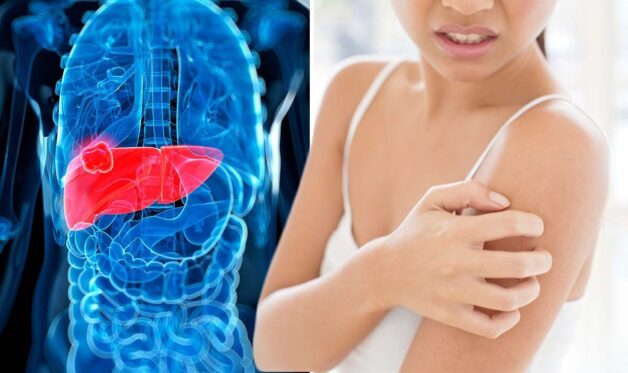 Ung thư bị phù chân và giải pháp chăm sóc cho người bệnh ung thư gan