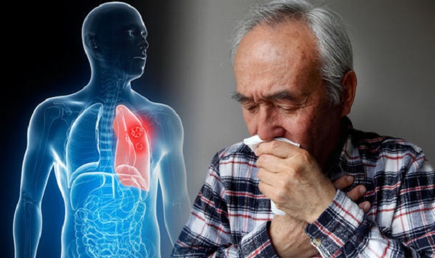 Triệu chứng của ung thư phổi giai đoạn đầu
