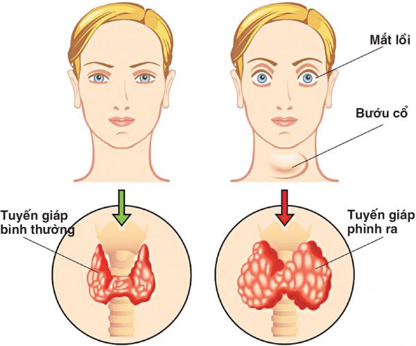Bệnh Basedown đặc trưng bởi bướu cổ, mắt lồi