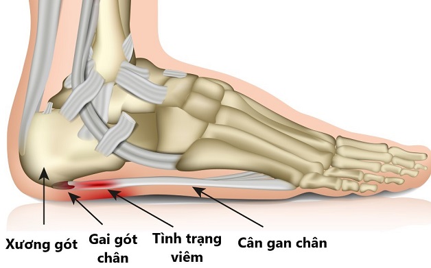 Viêm cân gan bàn chân là gì 