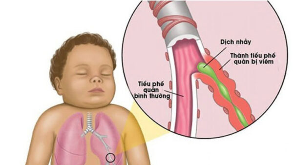 Trẻ viêm tiểu phế quản cấp có thể phải nhập viện điều trị-1