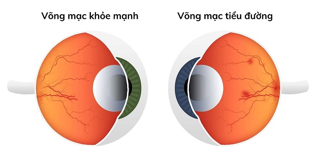 võng mạc tiểu đường