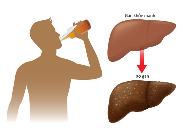 Mối liên hệ giữa ung thư gan rượu và sử dụng rượu quá mức