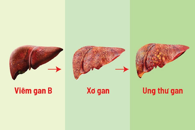 xơ gan ung thư hóa 