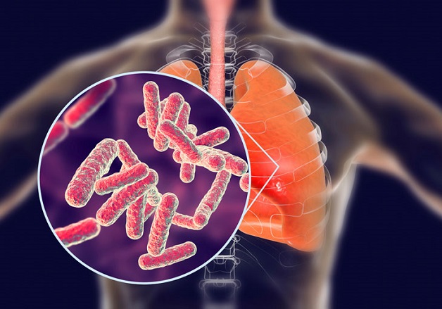 Lao phổi có thể phòng ngừa bằng cách tiêm vaccin lao