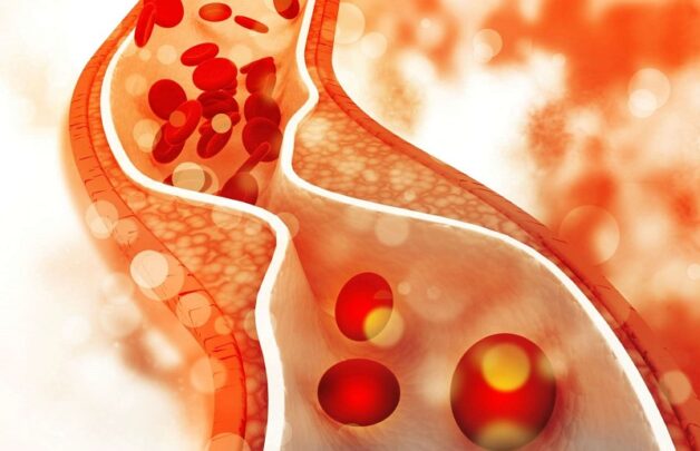 Ai có nguy cơ đột quỵ cao? Hàm lượng cholesterol trong máu cao cũng là nguyên nhân gây đột quỵ