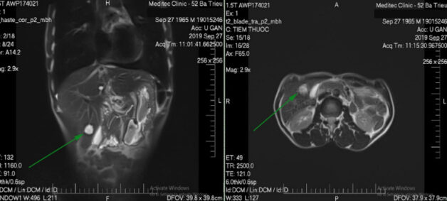Hình ảnh kết quả MRI tuyến thượng thận