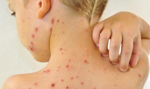 Không để trẻ gãi vào các nốt thủy đậu vì có thể gây biến chứng nhiễm trùng