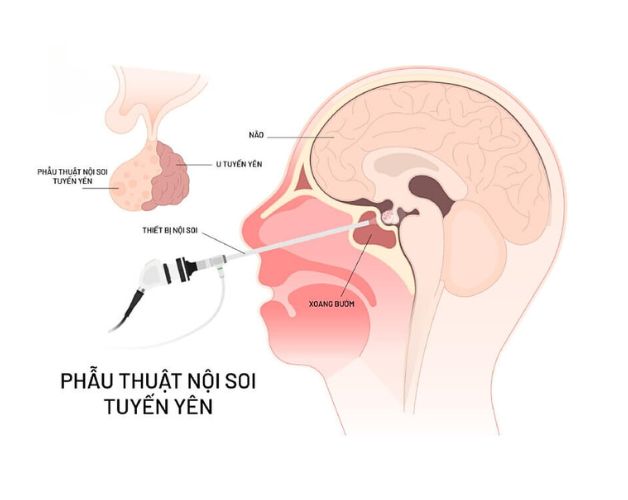 Phẫu thuật là một trong những cách điều trị u tuyến yên phổ biến