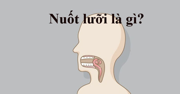 Tại sao đột quỵ lại nuốt lưỡi?