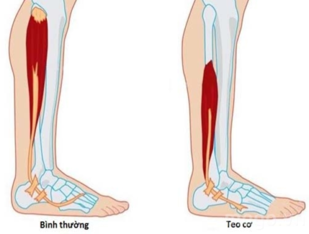 Teo cơ, yếu cơ là triệu chứng u tuyến thượng thận tiết cortisol