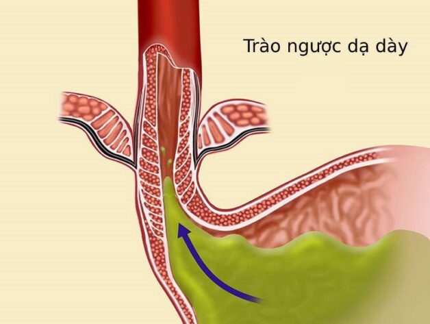 Hình ảnh trào ngược dạ dày