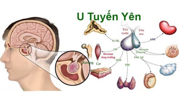 U tuyến yên bệnh học gây phiền toái cho nhiều người bệnh