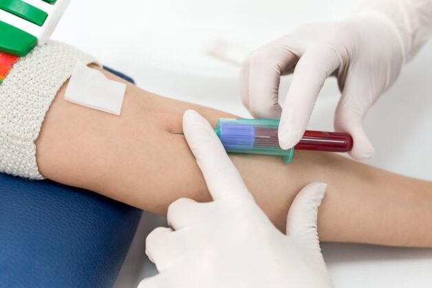 Xét nghiệm ACTH chẩn đoán suy tuyến thượng thận mạn