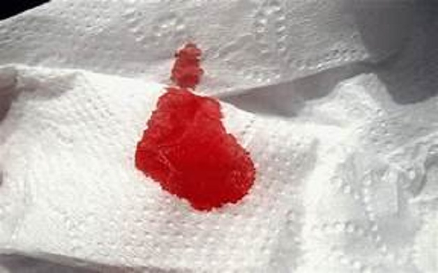 Bệnh trĩ có gây vô sinh