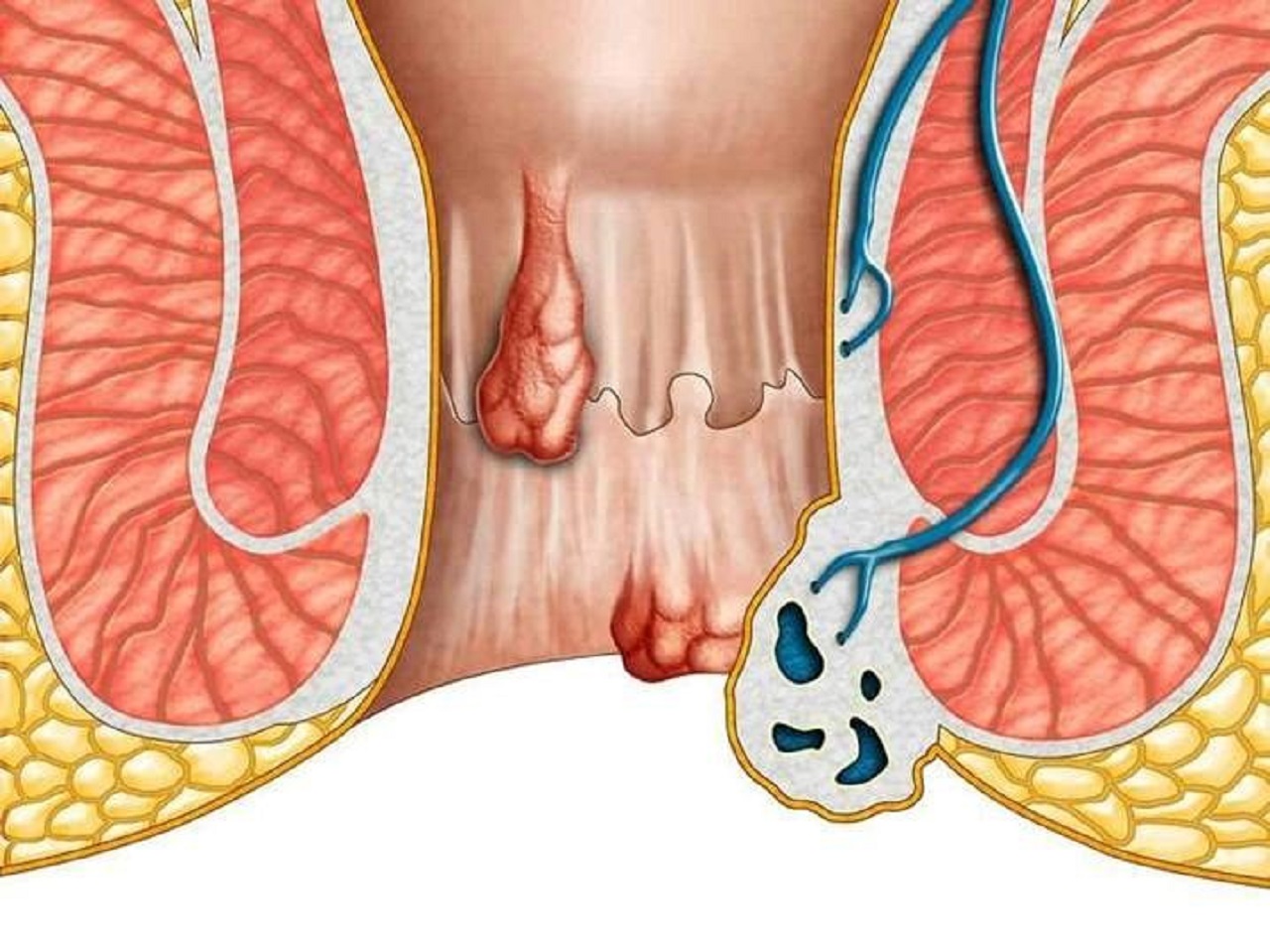 Bị bệnh trĩ có đi nghĩa vụ quân sự không 1