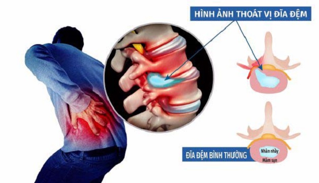 thoát vị đĩa đệm có đi bộ được không? có chạy bộ được không?