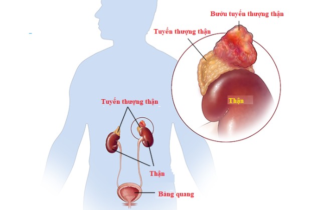 MRI giúp phân tích hình ảnh khối u tuyến thượng thận