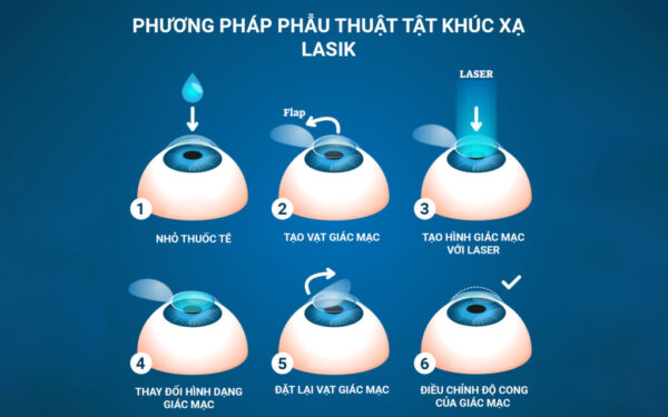 Các phương pháp điều trị tật khúc xạ bằng laser excimer: Lasik
