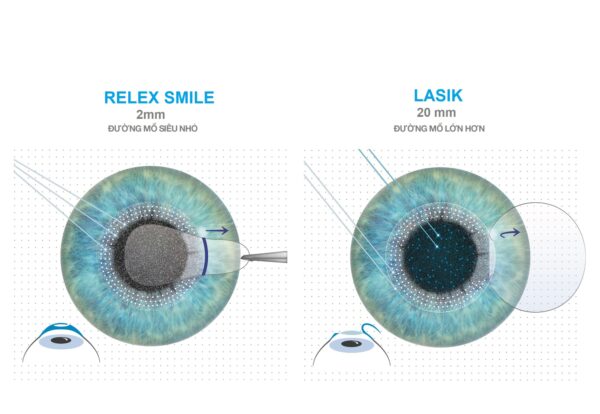 ReLEx SMILE tạo vết mổ rất nhỏ so với Lasik