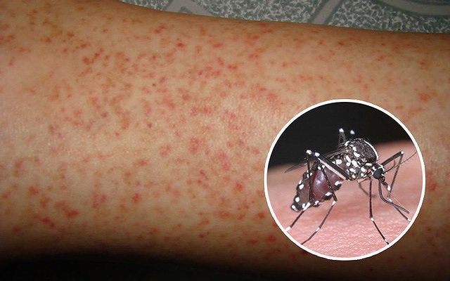 cách chăm sóc sốt xuất huyết cho mẹ bầu tại nhà