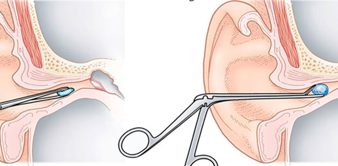 CÁCH LẤY DỊ VẬT RA KHỎI MẮT AN TOÀN HIỆU QUẢ