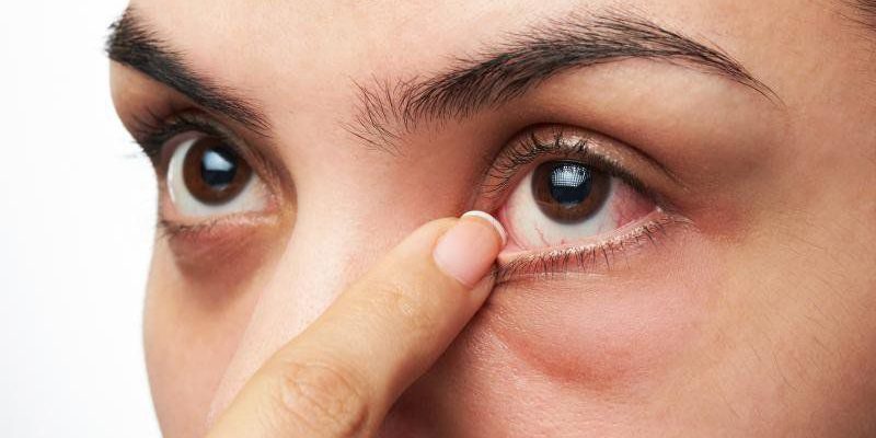 Người bệnh có thể bị đau mắt đỏ ở một hoặc cả hai mắt