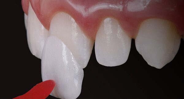 dán sứ veneer uy tín