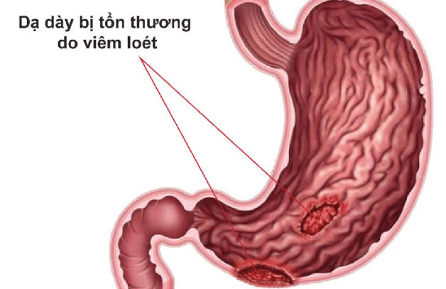 Đau dạ dày buồn nôn do viêm loét