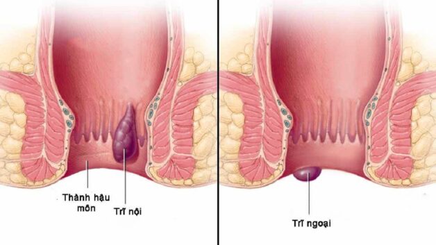 dấu hiệu bệnh trĩ nặng