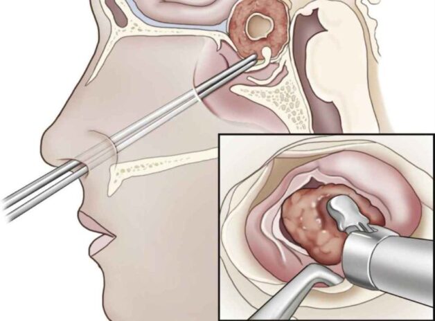 Bệnh nhân u tuyến yên lớn có thể phải phẫu thuật loại bỏ.