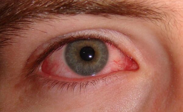 Đau mắt đỏ kéo dài không khỏi có nguy hiểm?