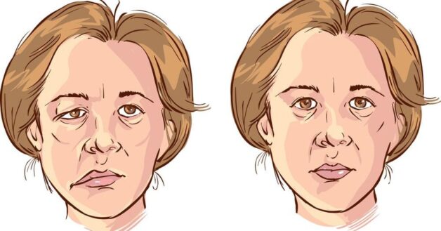 Liệt dây thần kinh, méo mặt là dấu hiệu của đột quỵ
