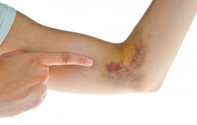 Gan nhiễm mỡ gây đau bụng, khiến da bầm tím, nổi mẩn ngứa