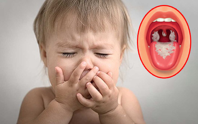 hệ lụy khi không tiêm bạch hầu đầy đủ cho trẻ